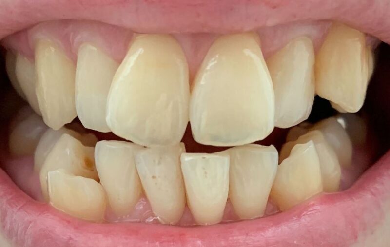 パールホワイトの効果は 歯は白くならない 実際に使ってみた口コミレビュー キレインボー